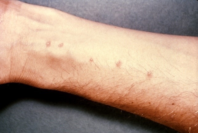 dermatitis por esquistosoma, enfermedad en la piel debido al agua contaminada