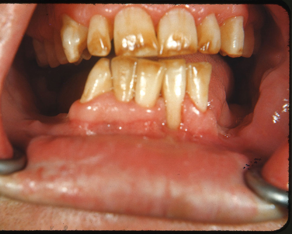 fluorosis dental